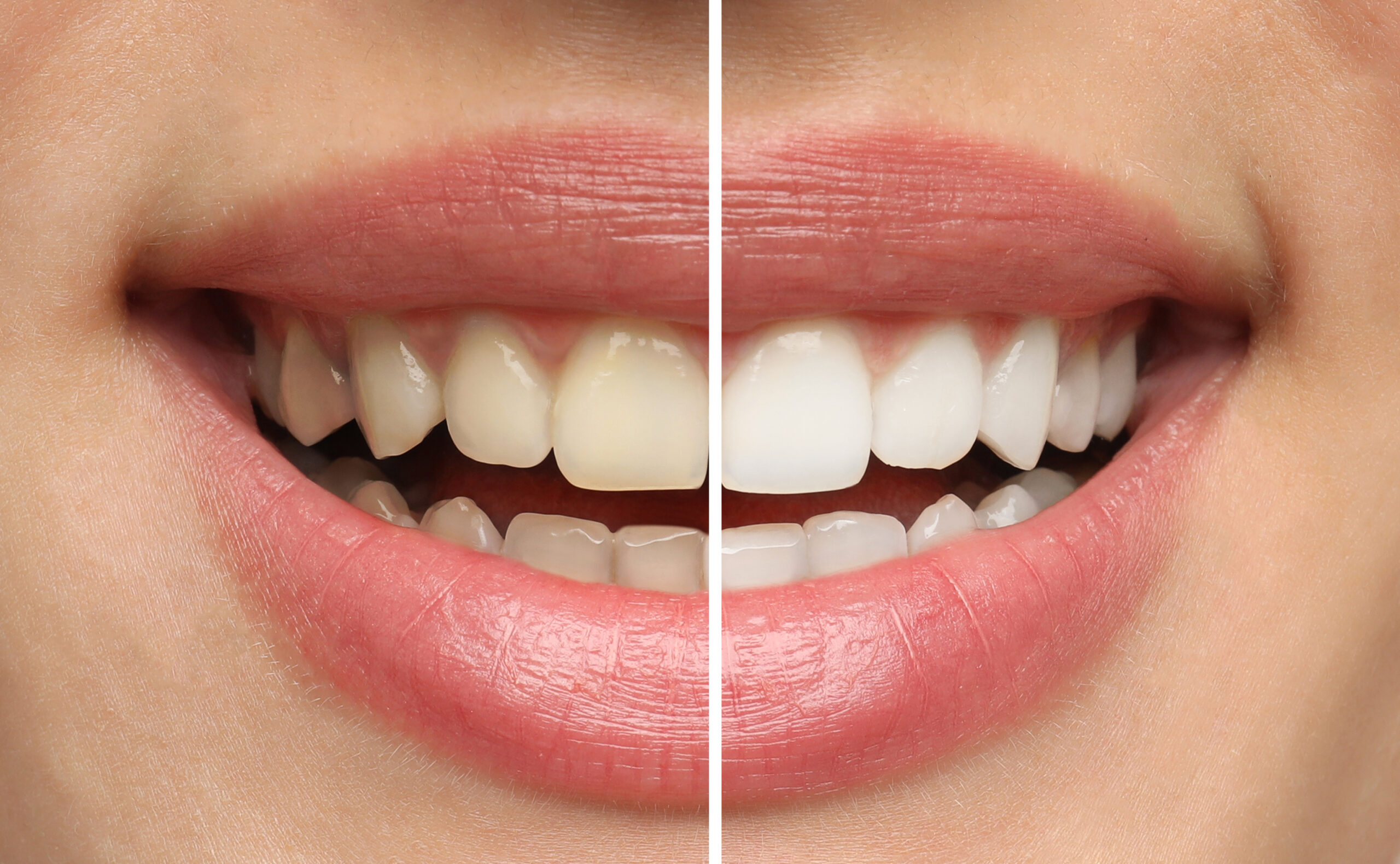 Veneers vs. Crowns: Which Option Is Right for Your Smile?