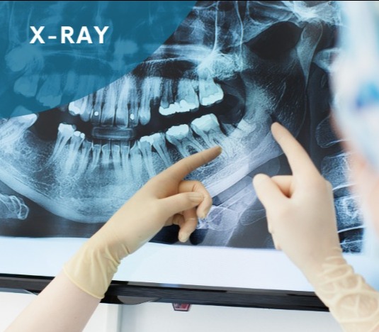 Enhance Your Oral Health with Advanced Dental X-Rays
