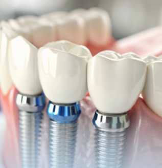 Dental Implants vs. Dentures in 2026: Which Is the Better Option for You?