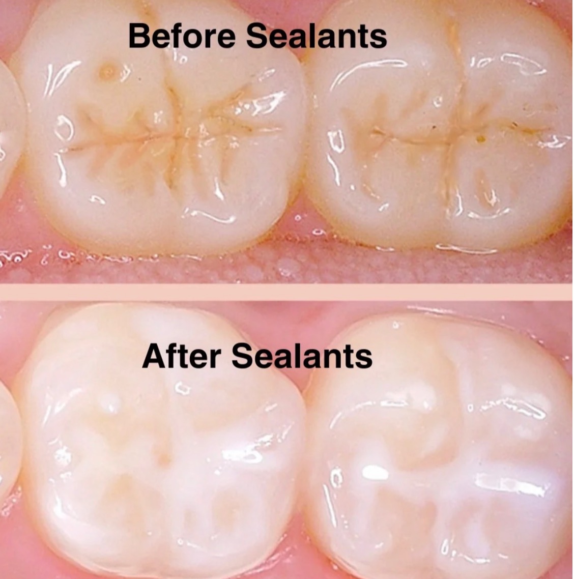 Why Dental Sealants are Essential for Kids Oral Health