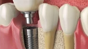 Benefits of Dental Implants