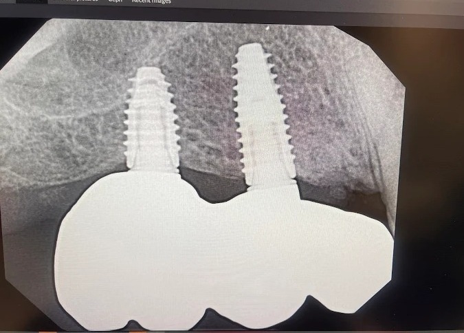 Dental Implants vs Dentures: Which Is the Best Option for Missing Teeth in 2026?