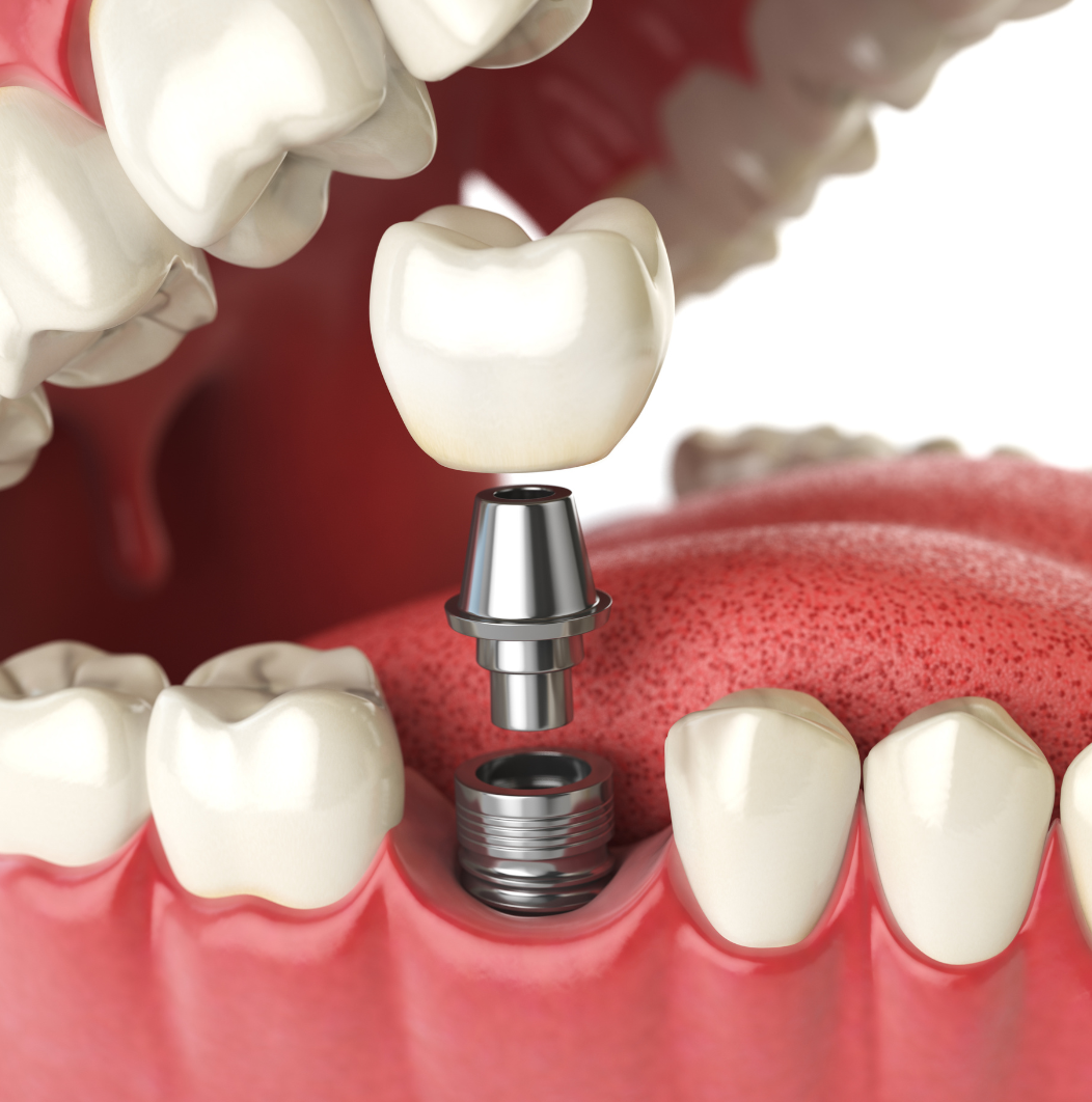 Find the Best Implant Dentist Near You for a Confident Smile