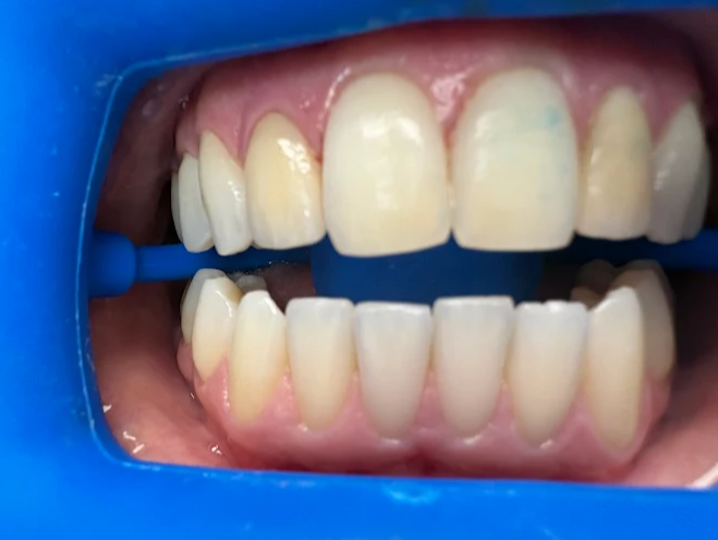 The Benefits of Professional Teeth Whitening for a Brighter Smile