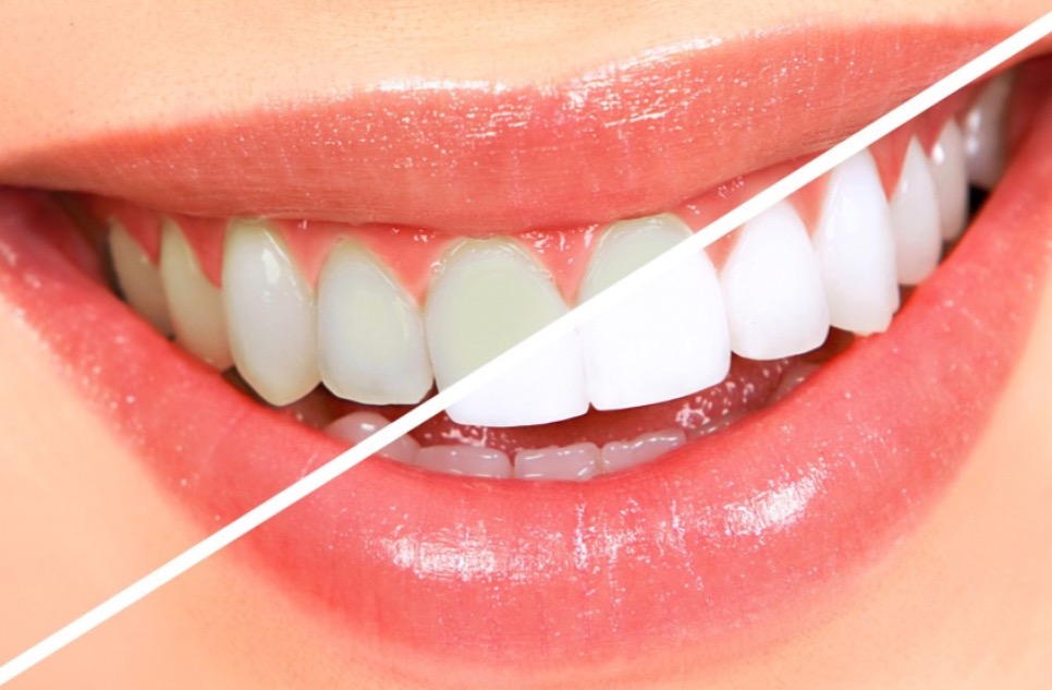 Transform Your Smile For New Job Opportunities With Teeth Whitening