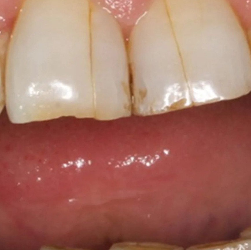 Cracked Tooth Solutions From Your Emergency Dentist