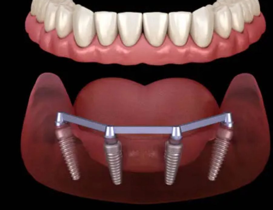 Affordable Dental Implants Near You By Bellagio