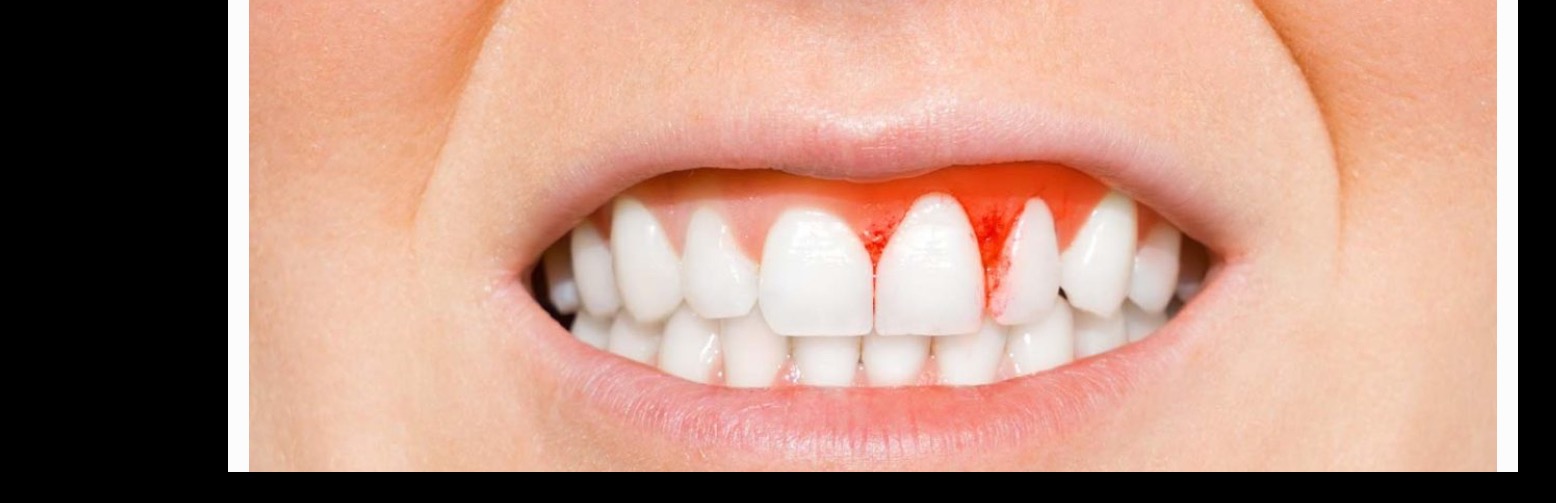 Understanding Periodontal Disease: Is It Truly Contagious?